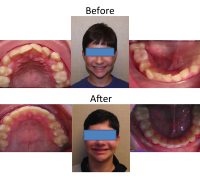 braces-orthodontist-nyc-before-after-52