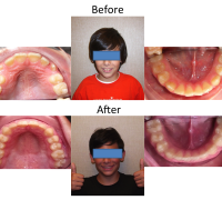 braces-orthodontist-nyc-before-after-53