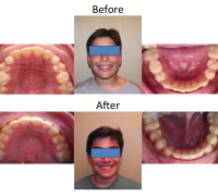 braces-orthodontist-nyc-before-after-54