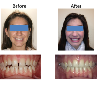 braces-orthodontist-nyc-before-after-55