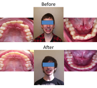 braces-orthodontist-nyc-before-after-56