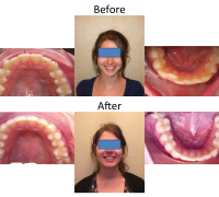 braces-orthodontist-nyc-before-after-57