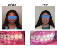 braces-orthodontist-nyc-before-after-58