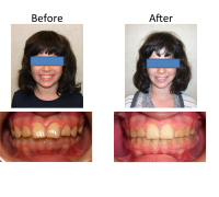 braces-orthodontist-nyc-before-after-59