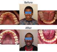 braces-orthodontist-nyc-before-after-6