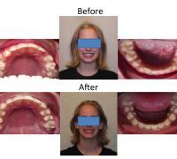 braces-orthodontist-nyc-before-after-60
