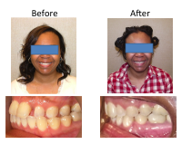 braces-orthodontist-nyc-before-after-61