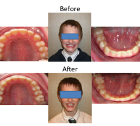 braces-orthodontist-nyc-before-after-62