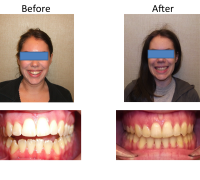 braces-orthodontist-nyc-before-after-63