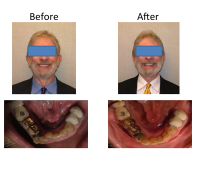 braces-orthodontist-nyc-before-after-64