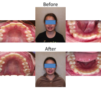 braces-orthodontist-nyc-before-after-65