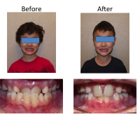 braces-orthodontist-nyc-before-after-66