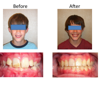 braces-orthodontist-nyc-before-after-67