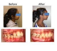 braces-orthodontist-nyc-before-after-68