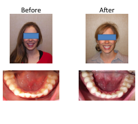 braces-orthodontist-nyc-before-after-69