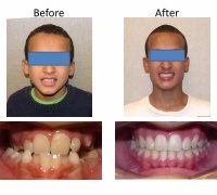 braces-orthodontist-nyc-before-after-7