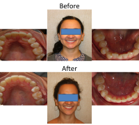 braces-orthodontist-nyc-before-after-70