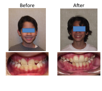braces-orthodontist-nyc-before-after-71