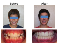 braces-orthodontist-nyc-before-after-72