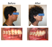 braces-orthodontist-nyc-before-after-73