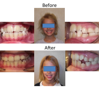 braces-orthodontist-nyc-before-after-74