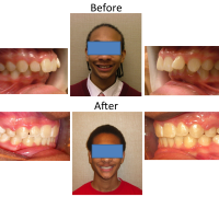 braces-orthodontist-nyc-before-after-75