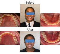 braces-orthodontist-nyc-before-after-76