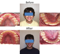braces-orthodontist-nyc-before-after-77