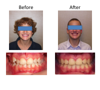 braces-orthodontist-nyc-before-after-78