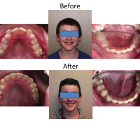 braces-orthodontist-nyc-before-after-79