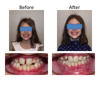 braces-orthodontist-nyc-before-after-8