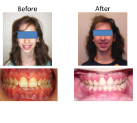 braces-orthodontist-nyc-before-after-80