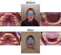 braces-orthodontist-nyc-before-after-81