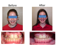 braces-orthodontist-nyc-before-after-82