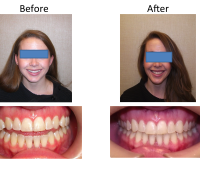 braces-orthodontist-nyc-before-after-83