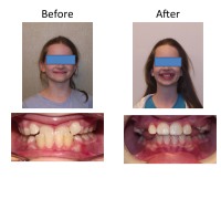 braces-orthodontist-nyc-before-after-84