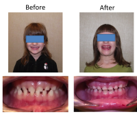 braces-orthodontist-nyc-before-after-85