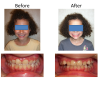 braces-orthodontist-nyc-before-after-86