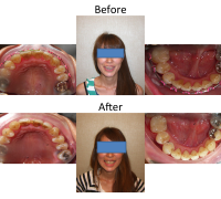 braces-orthodontist-nyc-before-after-87