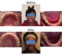 braces-orthodontist-nyc-before-after-88