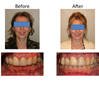 braces-orthodontist-nyc-before-after-89