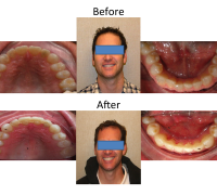 braces-orthodontist-nyc-before-after-9