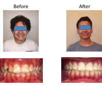 braces-orthodontist-nyc-before-after-90