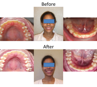 braces-orthodontist-nyc-before-after-91