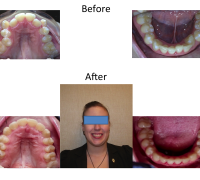 braces-orthodontist-nyc-before-after-92