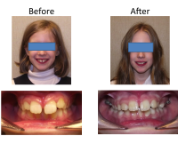 braces-orthodontist-nyc-before-after-93