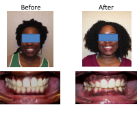 braces-orthodontist-nyc-before-after-94
