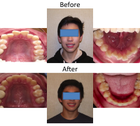 braces-orthodontist-nyc-before-after-95