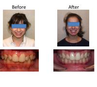 braces-orthodontist-nyc-before-after-96