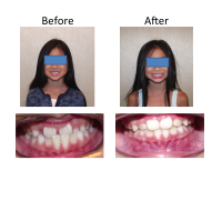 braces-orthodontist-nyc-before-after-97